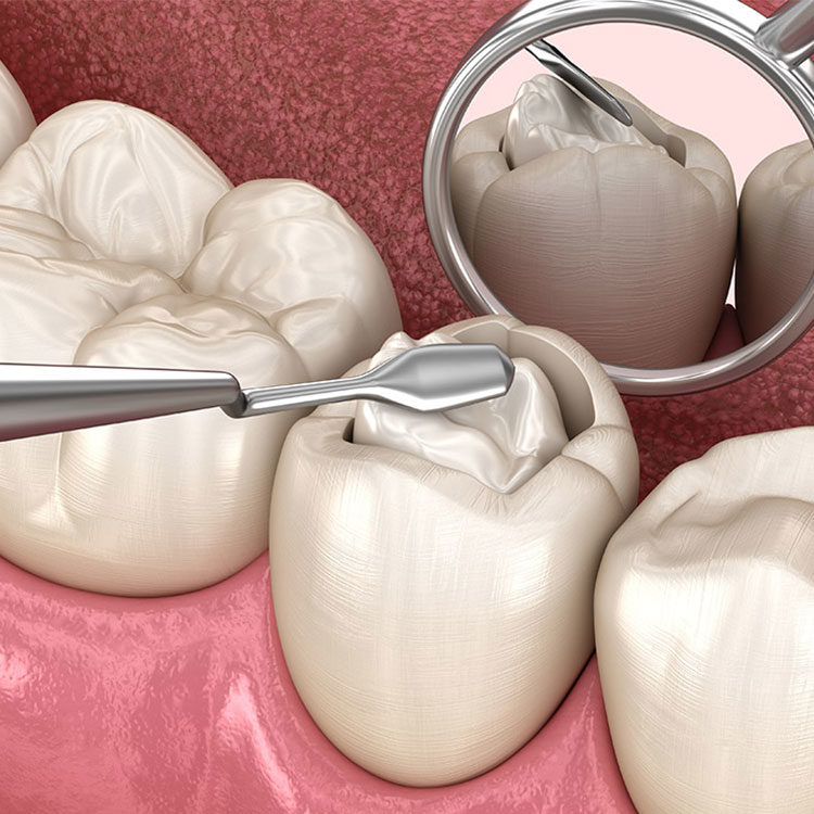 Examine the benefits of our dental fillings in St. Louis.
