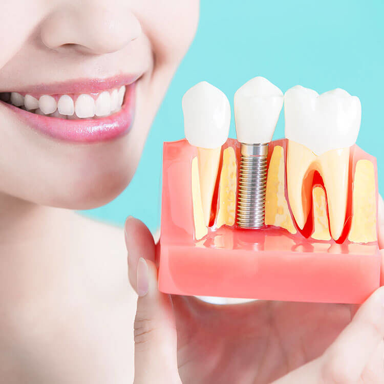Our St. Louis dentist used dental bridges to restore your missing teeth and the smile you desire.