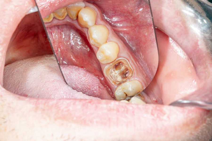 Pulp Exposure Tooth  