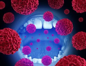 How Often Should You Have an Oral Cancer Screening Performed? Your St. Louis Dentist Weighs In
